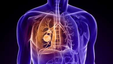 Los pacientes con cáncer de pulmón se enfrentan a tasas de supervivencia media a cinco años de sólo 17%. Lung cancer patients face median five-year survival rates of just 17%.